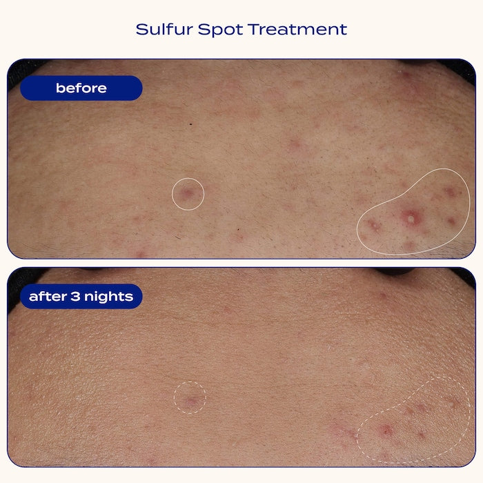 Sulfur Spot Treatment for Acne and Blemishes