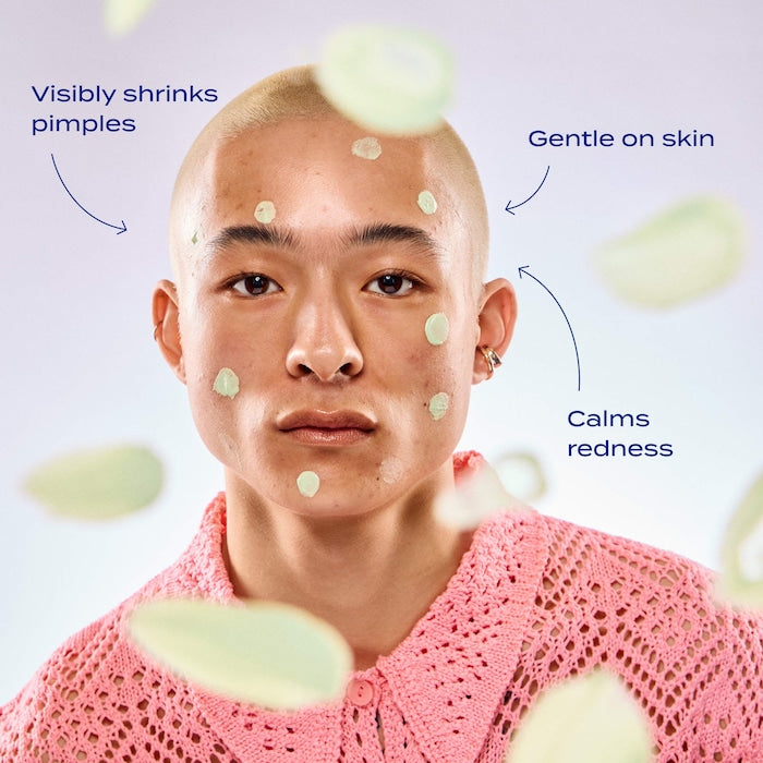 Sulfur Spot Treatment for Acne and Blemishes
