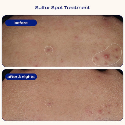 Sulfur Spot Treatment for Acne and Blemishes